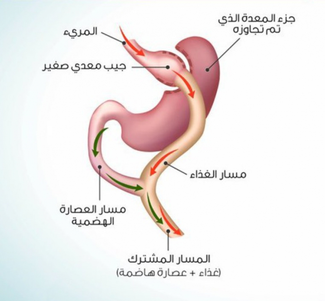 عملية تحويل مسار المعدة الكلاسيكي