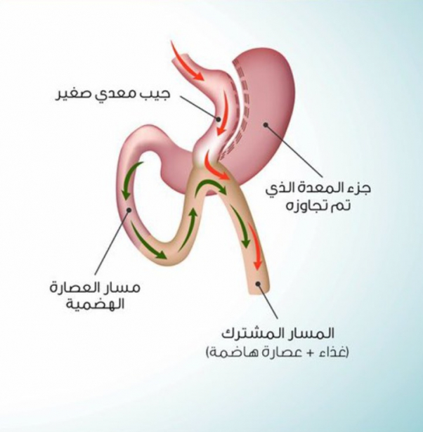 عملية تحويل مسار المعدة المصغر