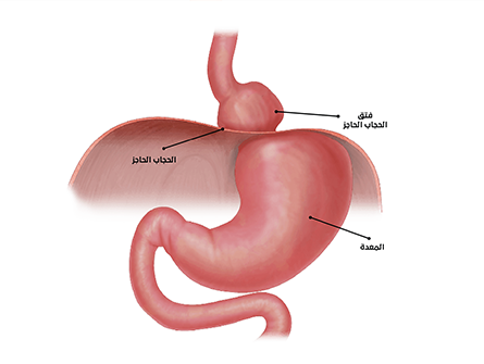 جراحة فتق الحجاب الحاجز